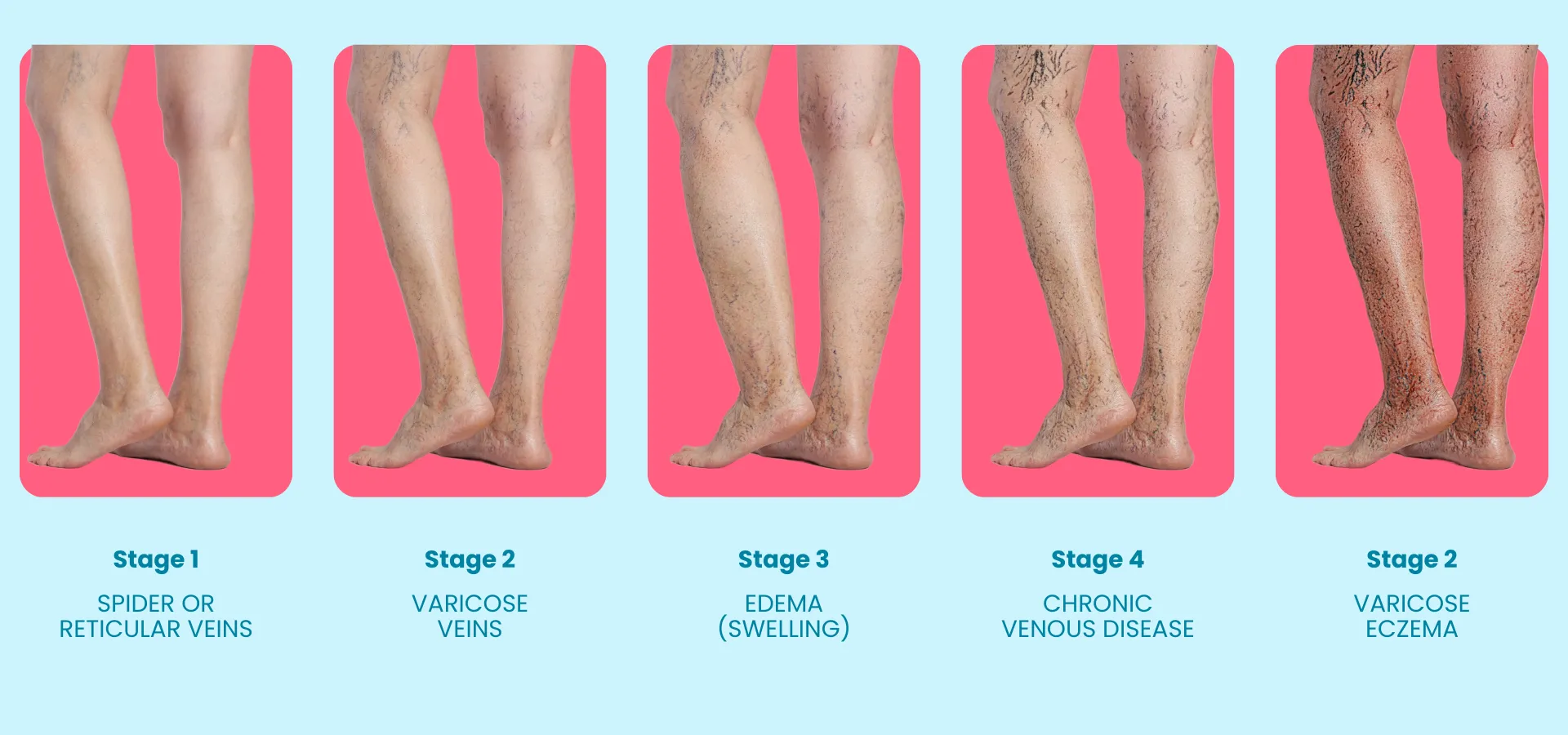 Varicose Veins or Discoloration in Skin