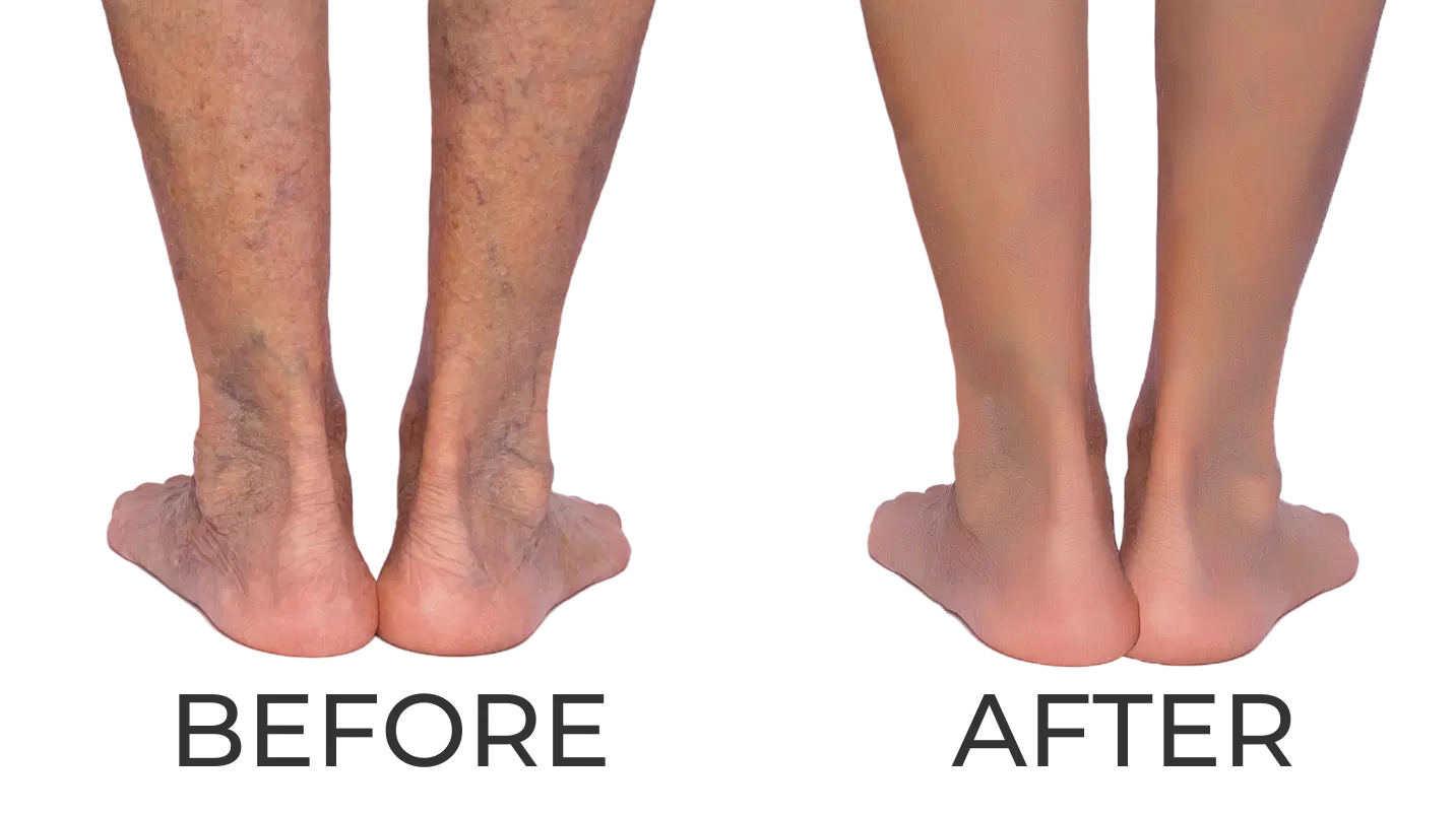 Texas Vein Experts I Treatment for Venous Disease, Varicose Veins, Painful  Veins in Legs