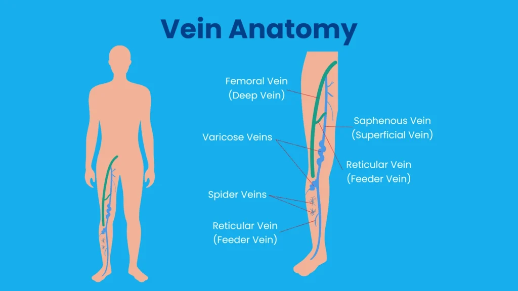 Varicose Veins