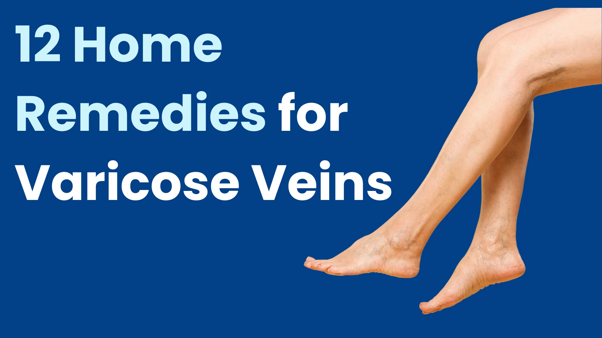 home remedies for varicose vein