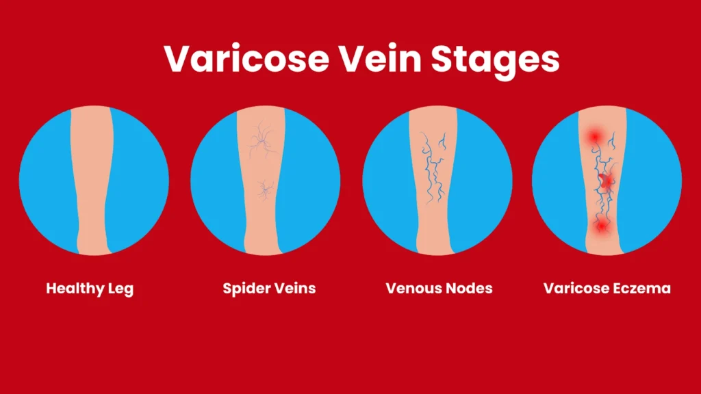varicose vein stages