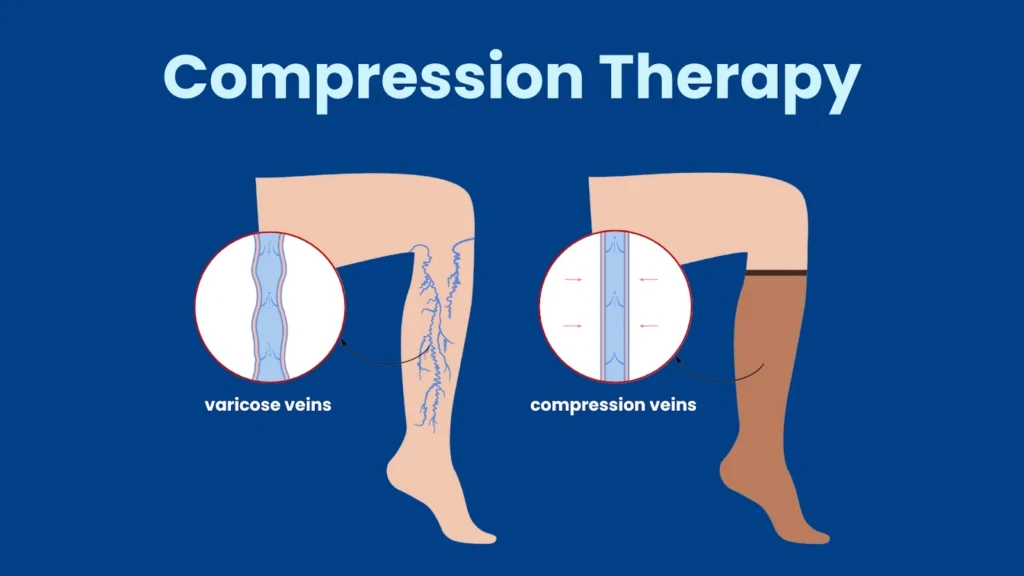 compression therapy