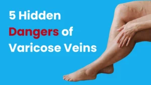 5 hidden dangers of varicose vein