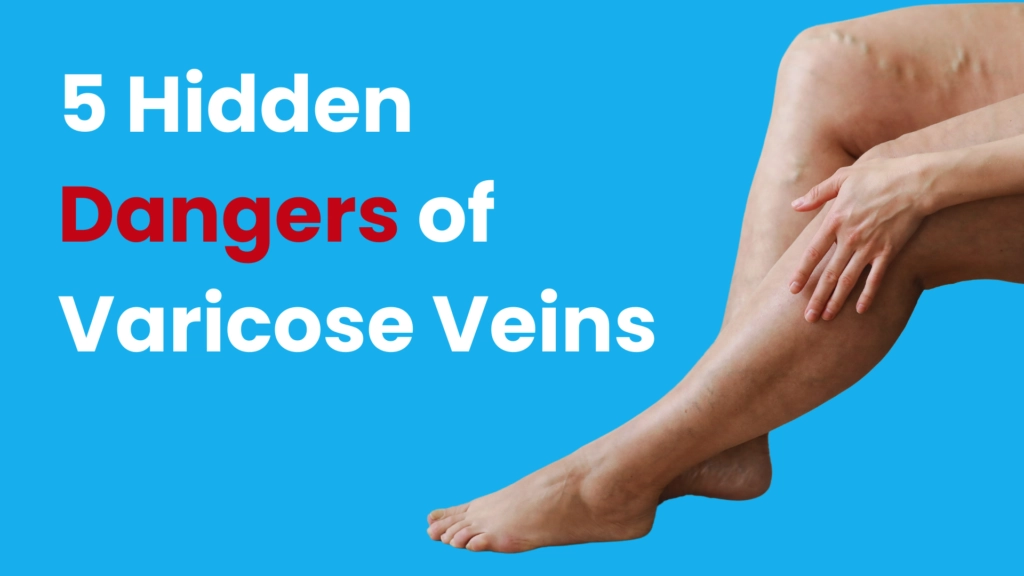 5 hidden dangers of varicose vein