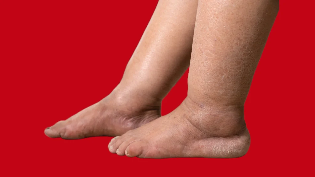 edema