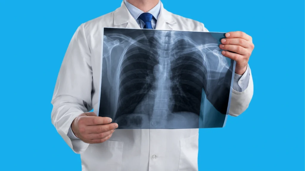 Pulmonary Embolism