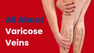 vericose vein
