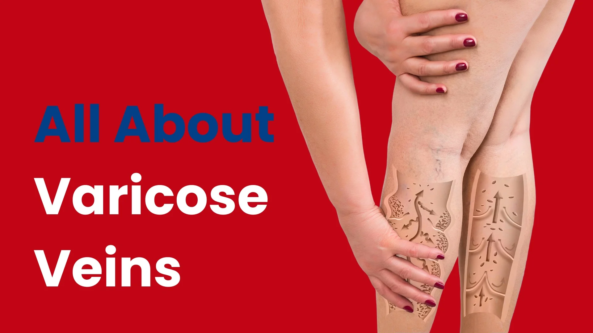 vericose vein