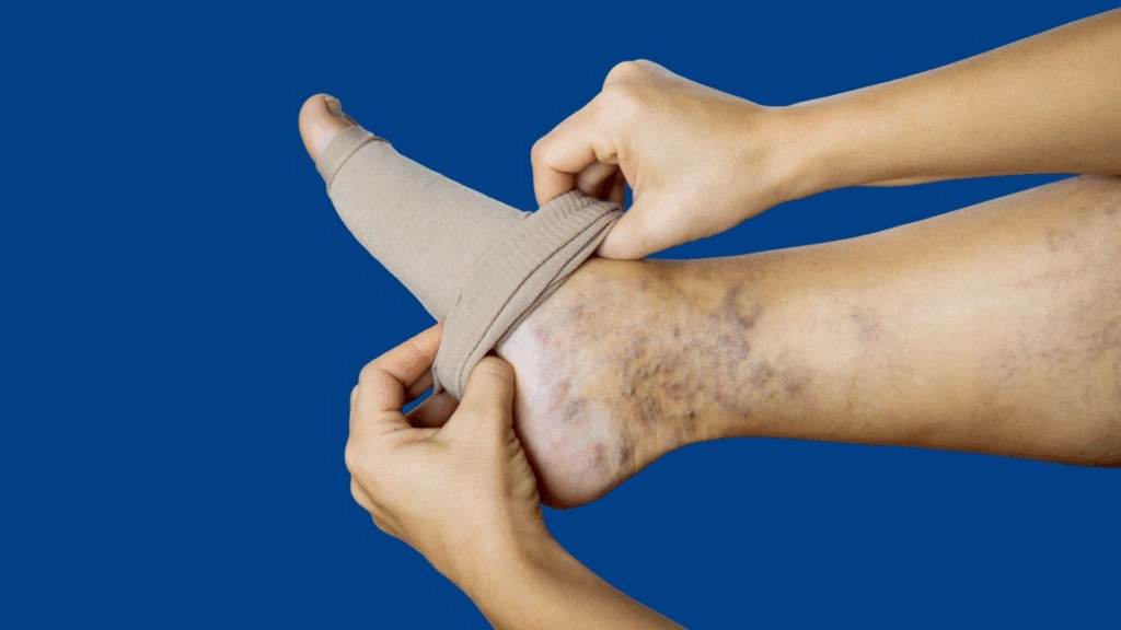 Varicose Veins