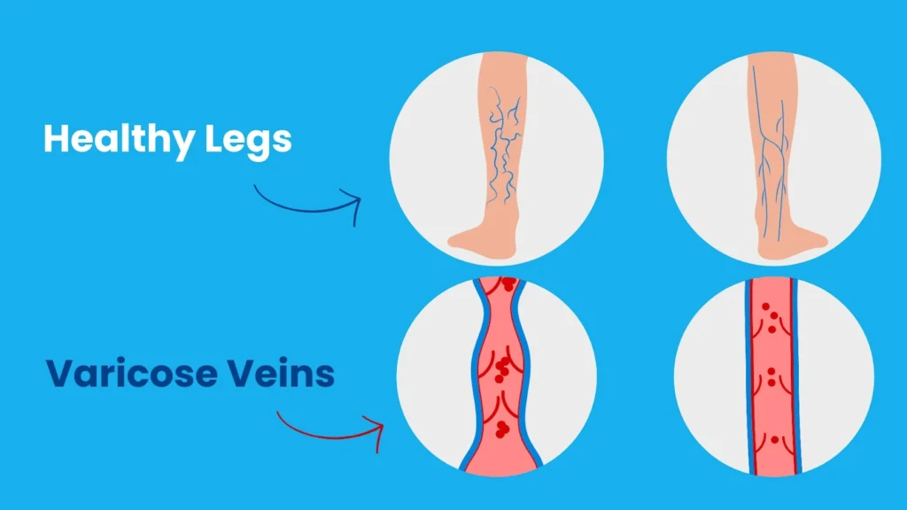 venous insufficiency