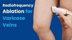 varicose vein