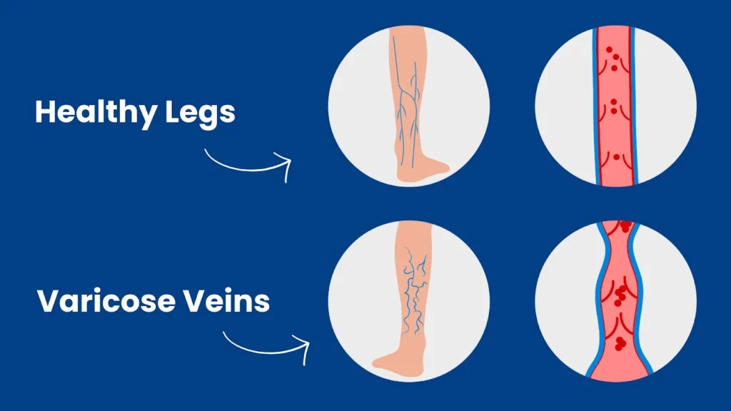varicose vein