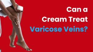 varicose vein