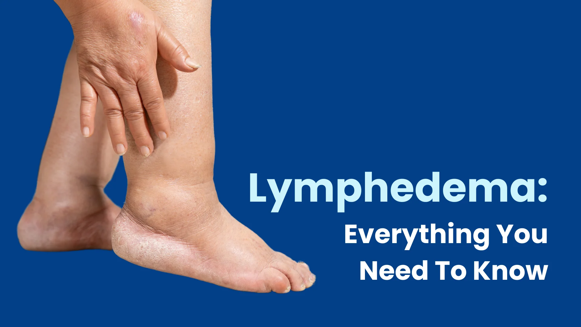Lymphedema Diagnosis