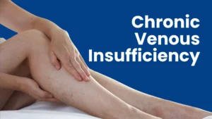varicose vein