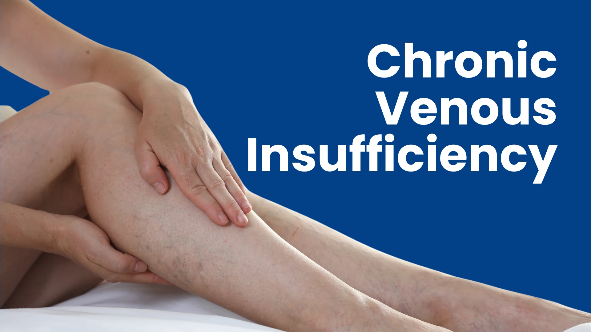 varicose vein