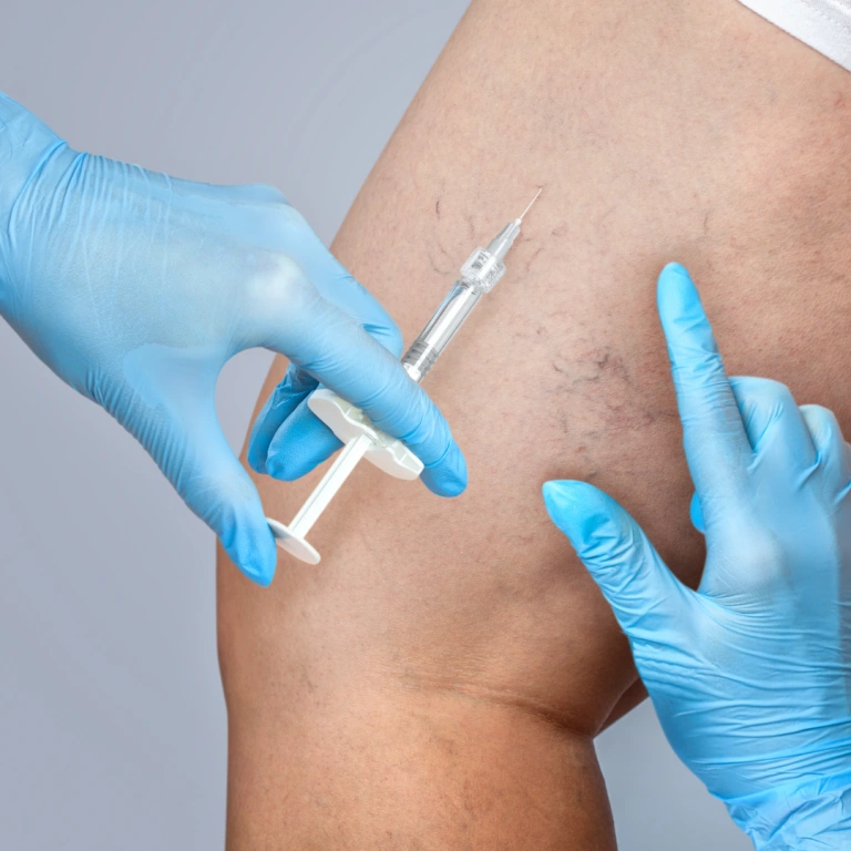 Compounded Sclerotherapy