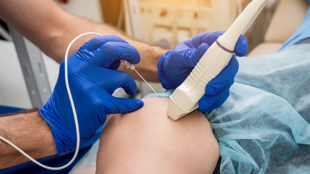 Varithena Ablation