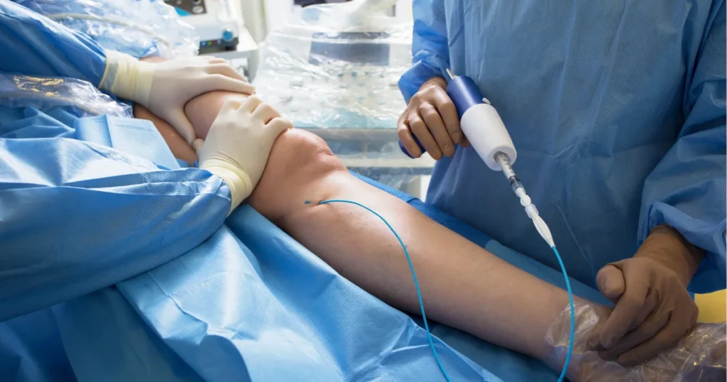 Tratamiento VenaSeal para las venas varicosas
